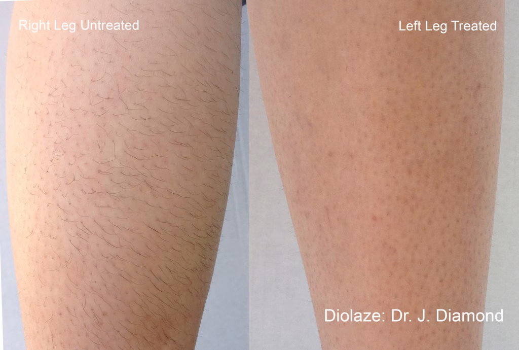 Is Diolaze Hair Removal Permanent