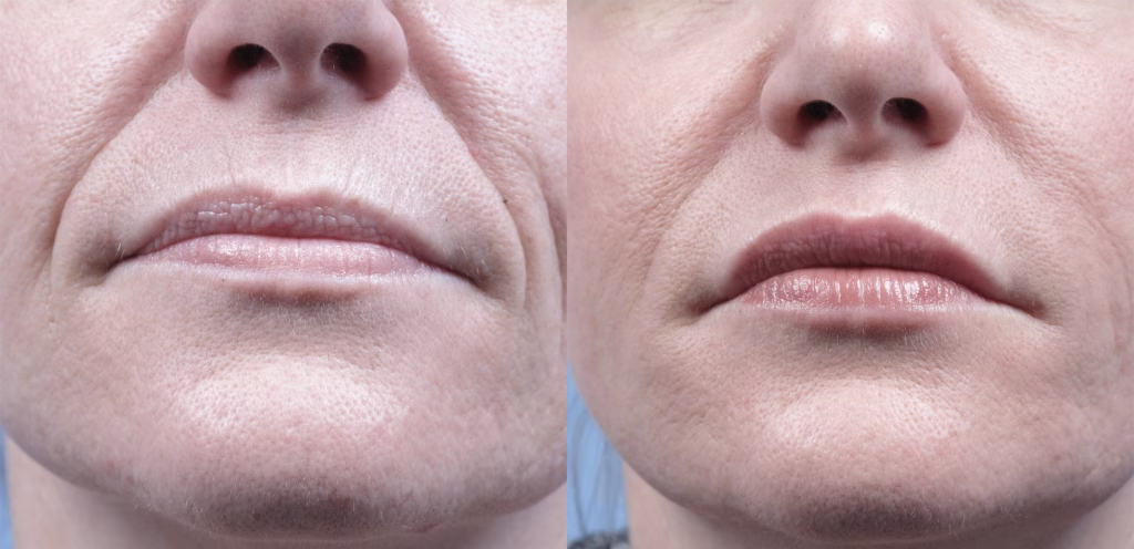 Skin Tightening