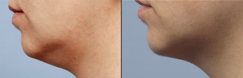 Skin Tightening